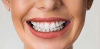 Get Your Teeth The Best Treatment with Ceramic Braces