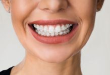 Get Your Teeth The Best Treatment with Ceramic Braces